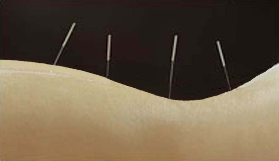 Restorative Acupuncture Gilian Lata LAc, Dipl OM — photo 1